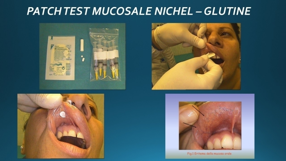 Nichel Sensitivity - ALLERBETA 
